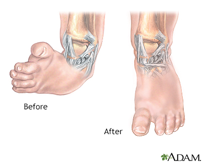 club foot treatment